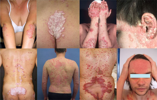 PSORIASIS